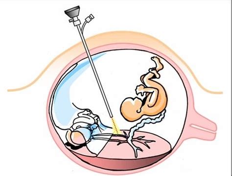 dvynių transfuzijos sindromo schema