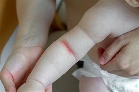 Vaizdinė instrukcija, kaip maudyti vaiką sergantį vėjaraupiais