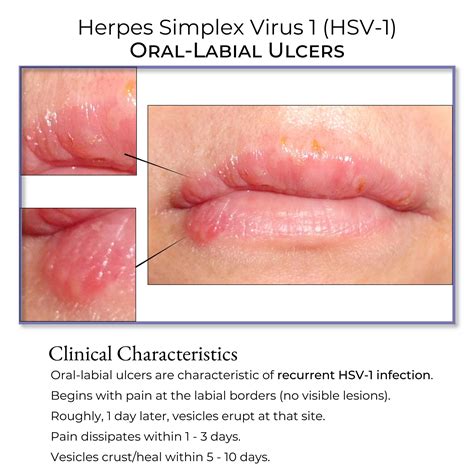 Herpes simplex viruso struktūra