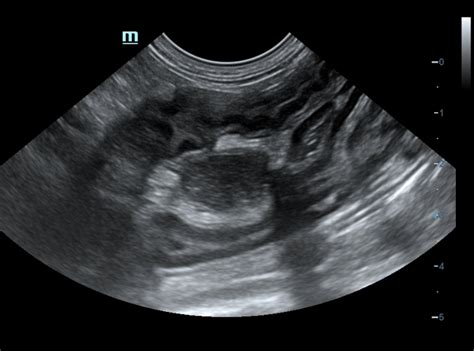 Ultragarsinio tyrimo metu matomas vaisiaus vaizdas