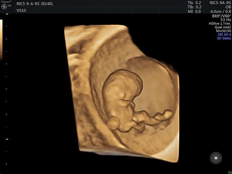 3D ultragarsinis vaisiaus veido atvaizdas