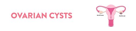 Moters reprodukcinė sistema ir kiaušidžių cistos