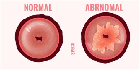 Schema, kaip atliekama gimdos kaklelio konizacija