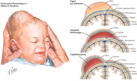 kefalohematoma naujagimio galvoje