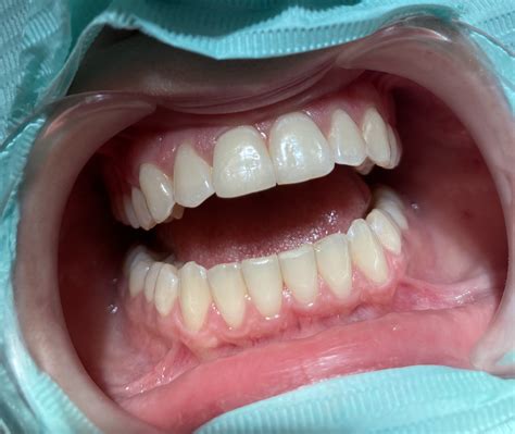 Nėščiųjų gingivito simptomai: paraudusios, paburkusios ir kraujuojančios dantenos