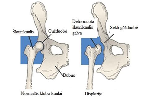 Klubo sąnario displazijos schema