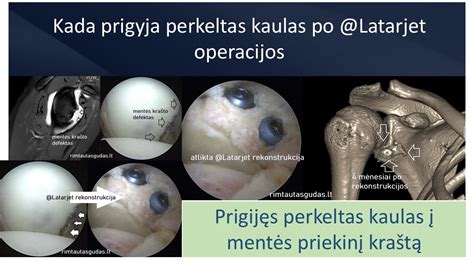 Grafikas parodantis kojų judesius po operacijos