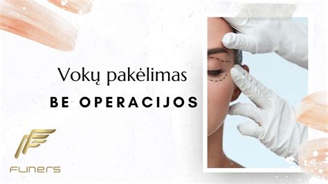 Schematinis IVF procedūros vaizdas