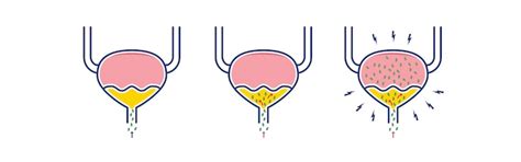 Schema: Šlapimo takų sistema ir galimos infekcijos vietos