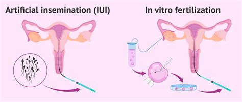 schema of artificial insemination