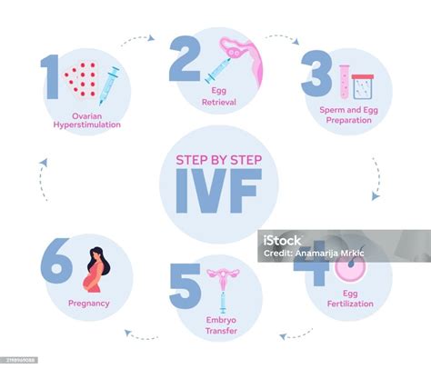 IVF procedure infographic