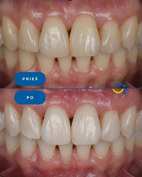 Infografika, rodanti kreivų dantų sukeliamas problemas: estetinės, funkcinės, sveikatos