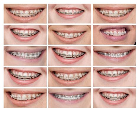 Nuotrauka su skirtingų tipų breketais (metaliniu, keraminiu)