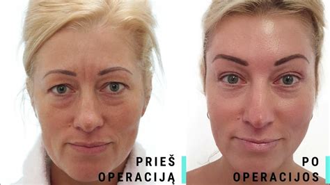 Oksanos Pikul plastinės operacijos rezultatai
