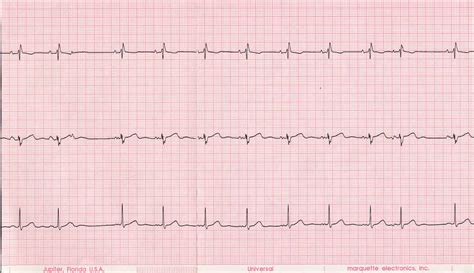 EKG grafikas
