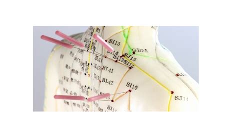 Akupunktūros schema