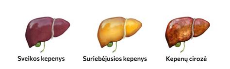 Medicininė schema: kepenų vėžio metastazės