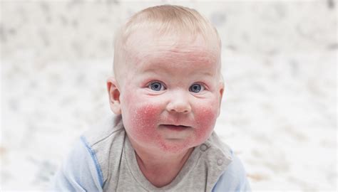 Kūdikio veidas su atopinio dermatito bėrimais