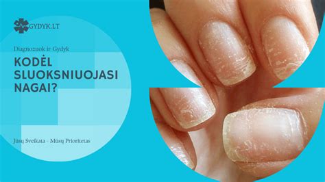 Priežastys, dėl kurių sluoksniuojasi nagai