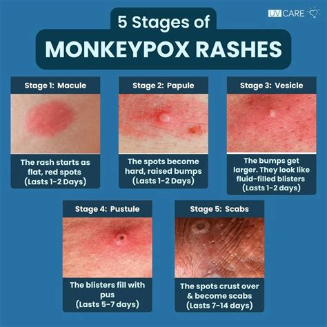 schema of monkeypox rash development