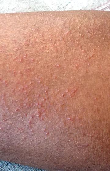 Skarlatinos bėrimas ant odos