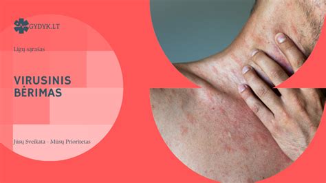 Limfmazgių patinimas ir smulkus bėrimas yra raudonukės požymiai.