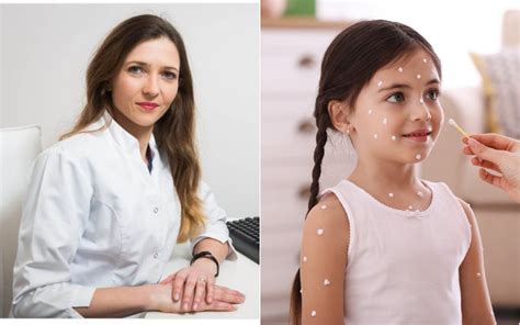 Vėjaraupių bėrimas, primenantis žvaigždėtą dangų, yra būdingas šiai ligai.