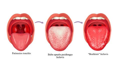 Avietės formos liežuvis ir paraudusi gerklė yra skarlatinos požymiai.