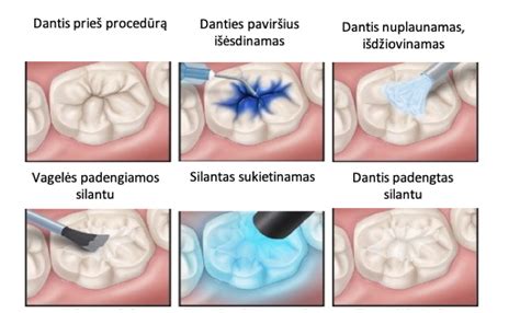 Dantų silantai - schema