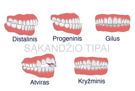 Sąkandžio tipai: atviras, gilus, kryžminis