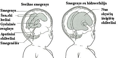 Scheminis smegenų skilvelių vaizdas