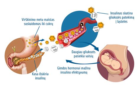 Simptomai ir apžiūra intrahepatinės nėščiųjų cholestazės atveju
