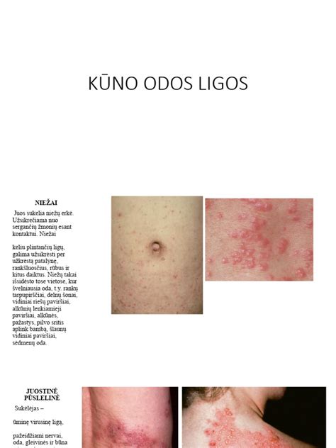 Schema: Nėštumo metu pasireiškiančios odos ligos