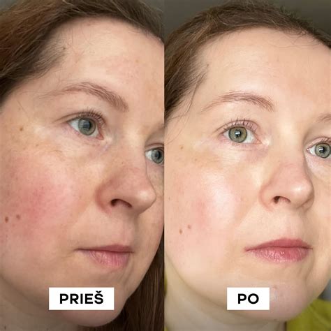 Infografika: Rožinės simptomai ir gydymas