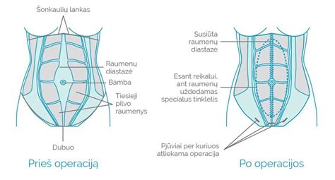 schematinis pilvo raumenų diastazės vaizdavimas