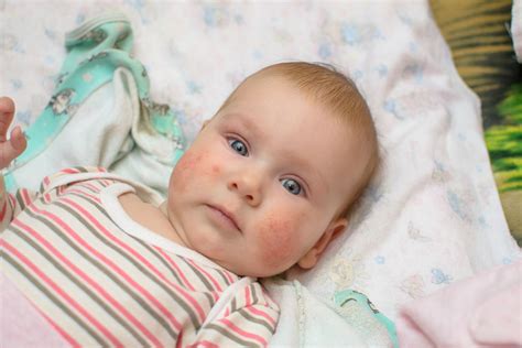 Vaikas su atopiniu dermatitu ant skruostų