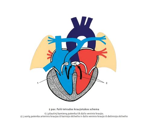 Schemoje pavaizduotos dažniausios įgimtos širdies ydos