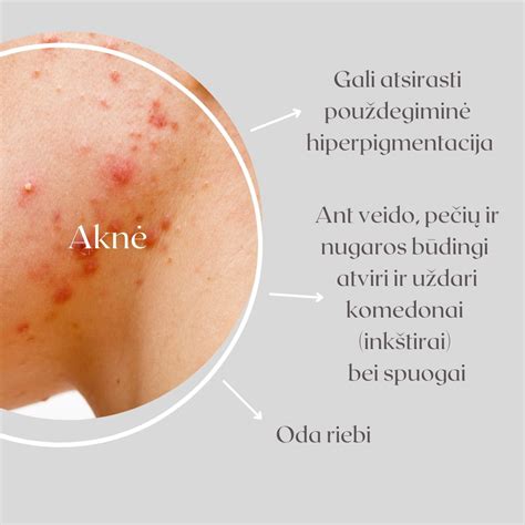 Nuotraukos, iliustruojančios skirtingus baltmės tipus ant odos