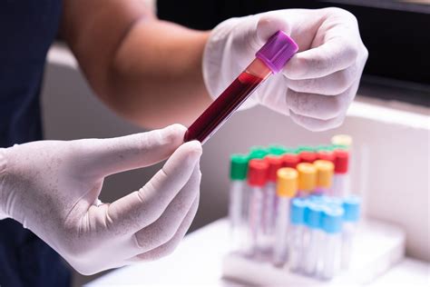 Nuotrauka: laboratorinis kraujo tyrimas