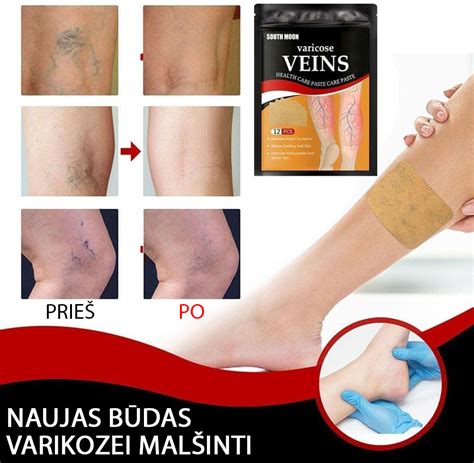 Varikozės paveiktos kojos