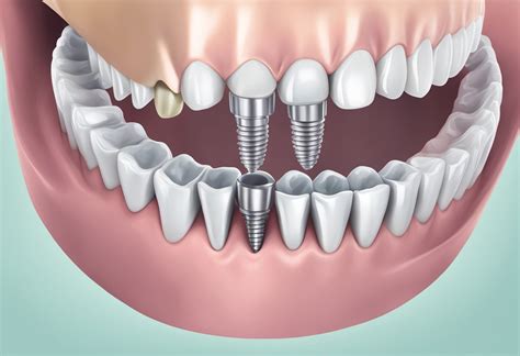 Implantacijos procesas