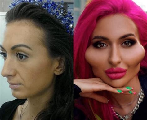 Prieš ir po plastinės operacijos