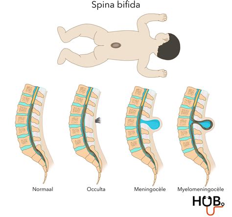 Spina bifida scheminis vaizdas