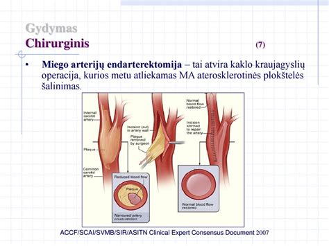 Chirurginis adenoidų šalinimas