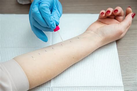 Alergologas atlieka odos dūrio testą