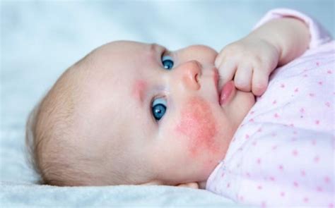 kūdikis su odos bėrimu