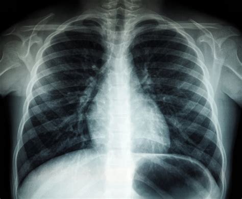 Vaiko krūtinės ląstos rentgeno nuotrauka su akcentu ant plaučių