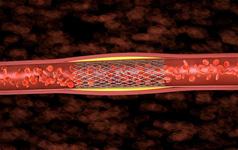 Implantacinis kraujavimas moters kūne