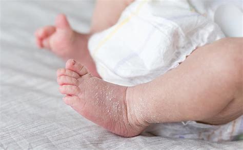 Lanugo plaukeliai ant naujagimio odos