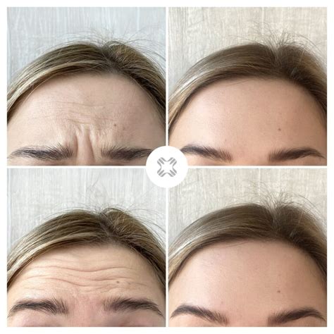 Palyginimas: botulino toksino injekcijos prieš ir po procedūros